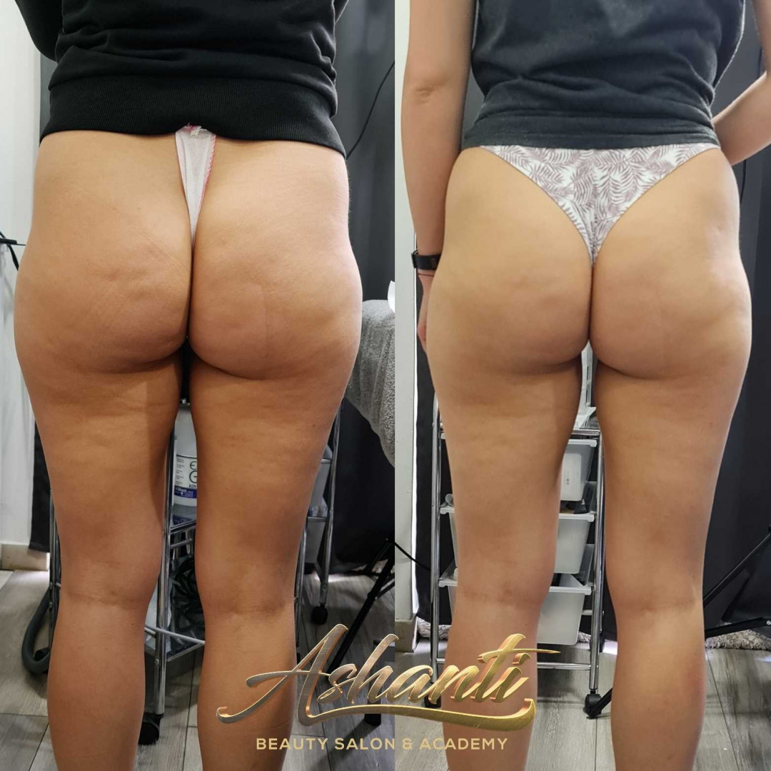 Ashanti Beauty Salon & Academy #beograd Tretmani tela Ultrazvučna kavitacija + radiotalasni lifting - po regiji