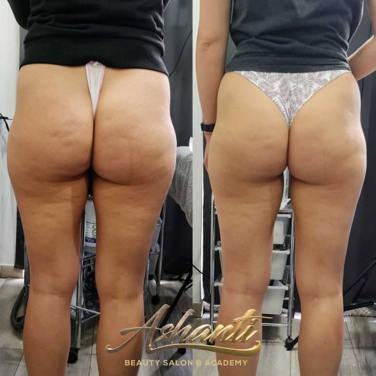 Ashanti Beauty Salon & Academy #beograd Tretmani tela Ultrazvučna kavitacija + radiotalasni lifting