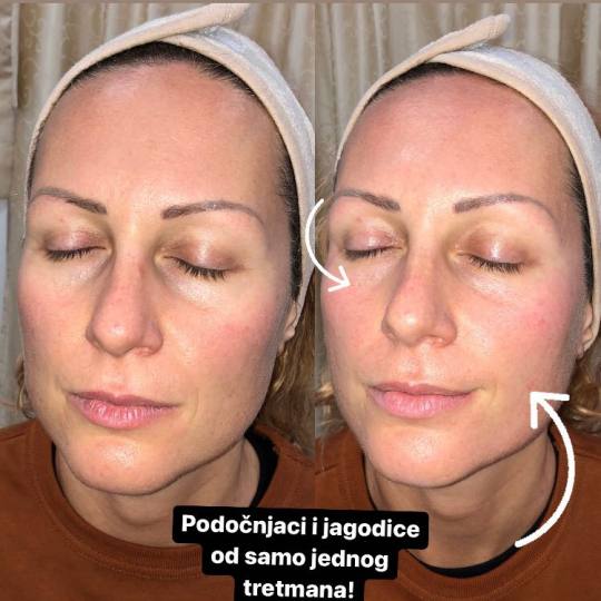 Makeup Olja Grbić #novisad Tretman lica Face gym masaža Face up tretman za zatezanje bora i miši