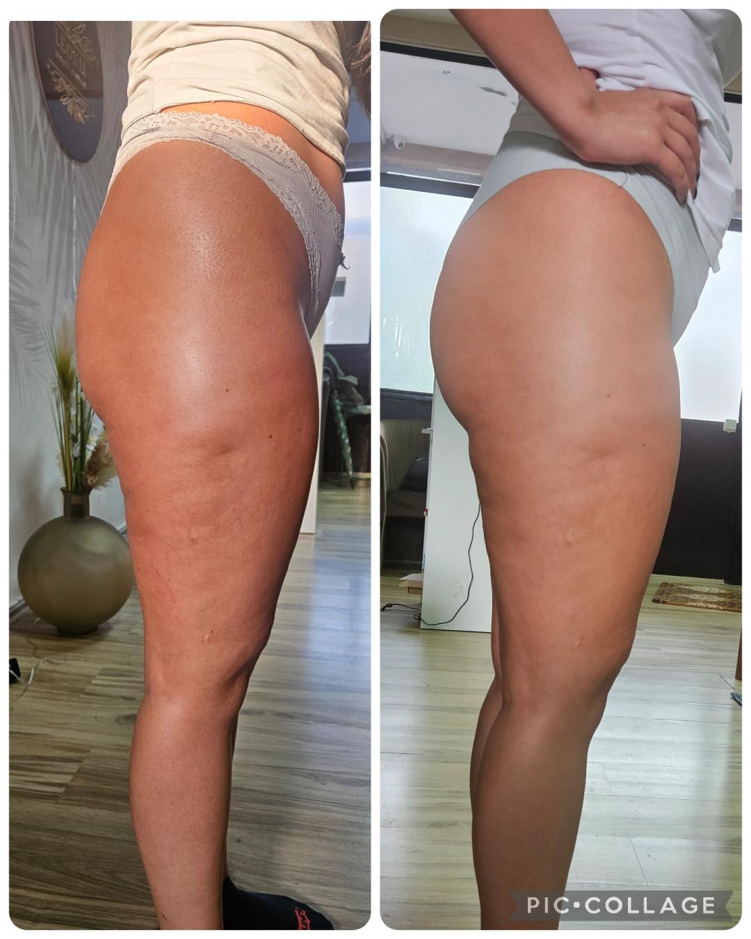 Maderoterapija - Leonis Beauty Premium, Beograd Anticelulit masaža Masaža Anticelulit masaža, Beograd, Novi Beograd blokovi, Belville, Savski kej