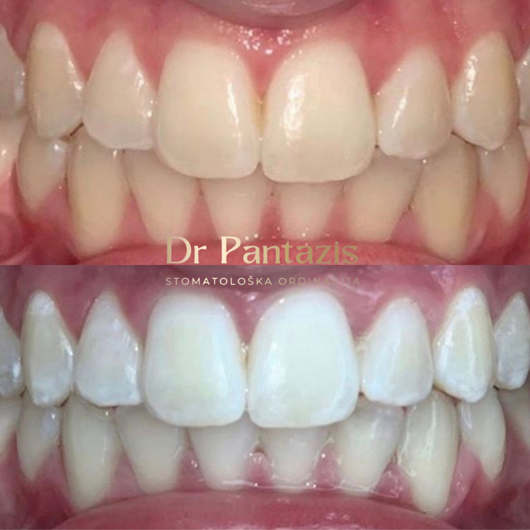 Dr Pantazis - Dental & Beauty Clinic #beograd Zubi Lasersko Profesionalno Izbeljivanje Zuba