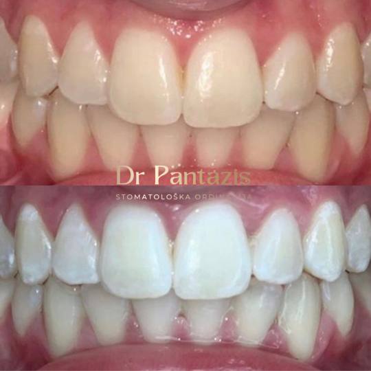 Dr Pantazis - Dental & Beauty Clinic #beograd Zubi Lasersko Profesionalno Izbeljivanje Zuba