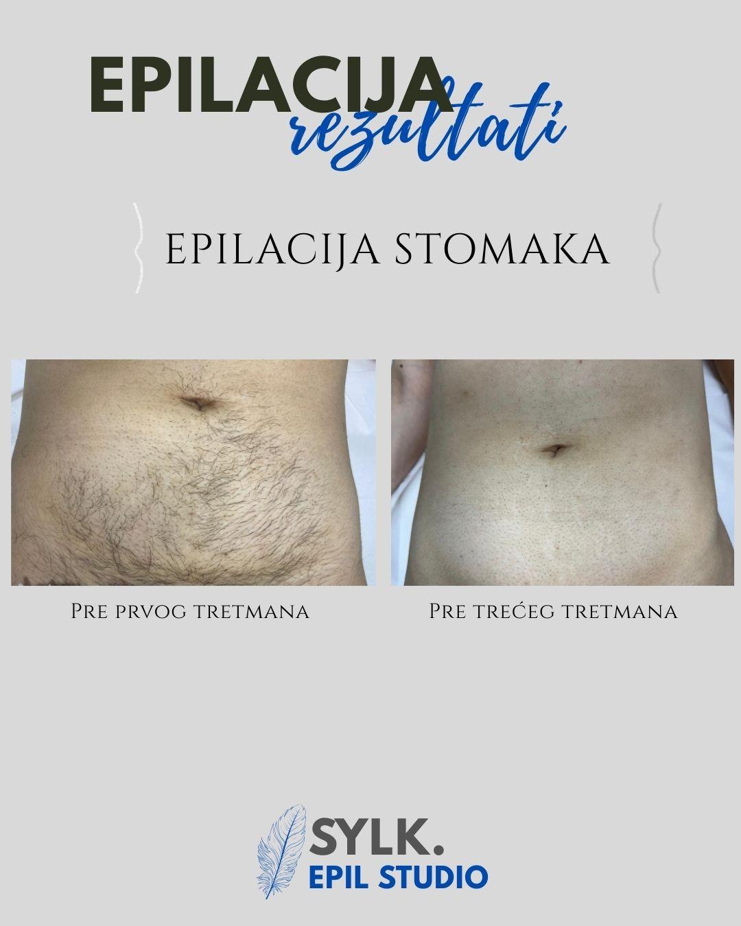 SYLK. Epilstudio Jagodina #jagodina Laserska epilacija Laserska epilacija stomaka - za dame