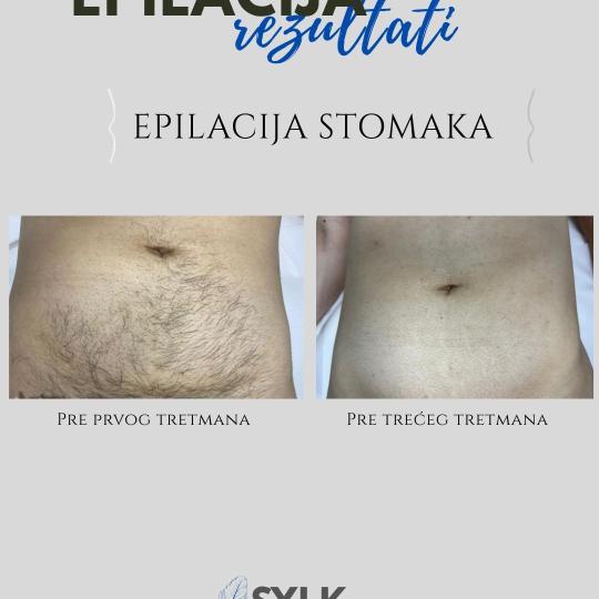 SYLK. Epilstudio Jagodina #jagodina Laserska epilacija Laserska epilacija stomaka - za dame