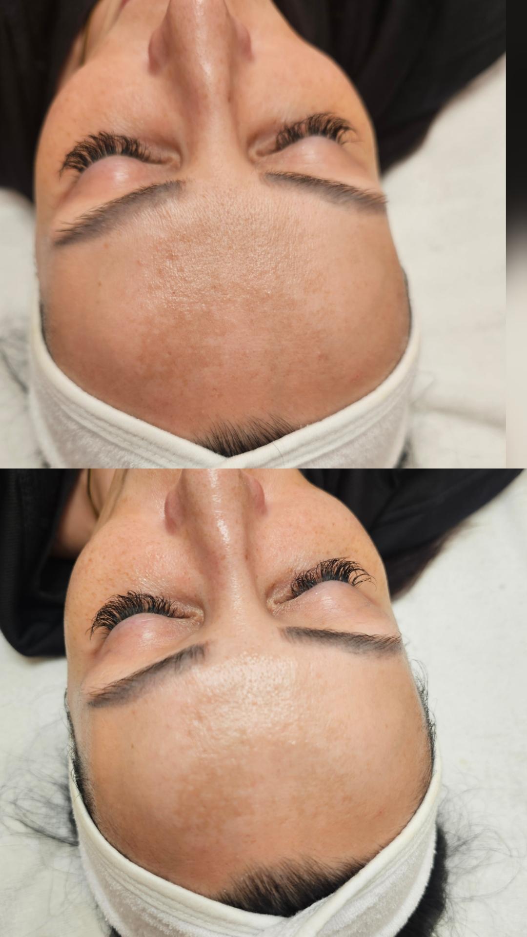 Choco Love #beograd Dermaroler i dermapen Dermapen tretman + Hemijski piling