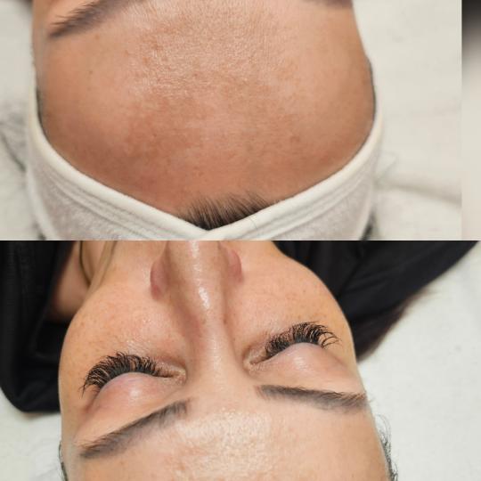 Choco Love #beograd Dermaroler i dermapen Dermapen tretman + Hemijski piling Dermapen + hemijski pil