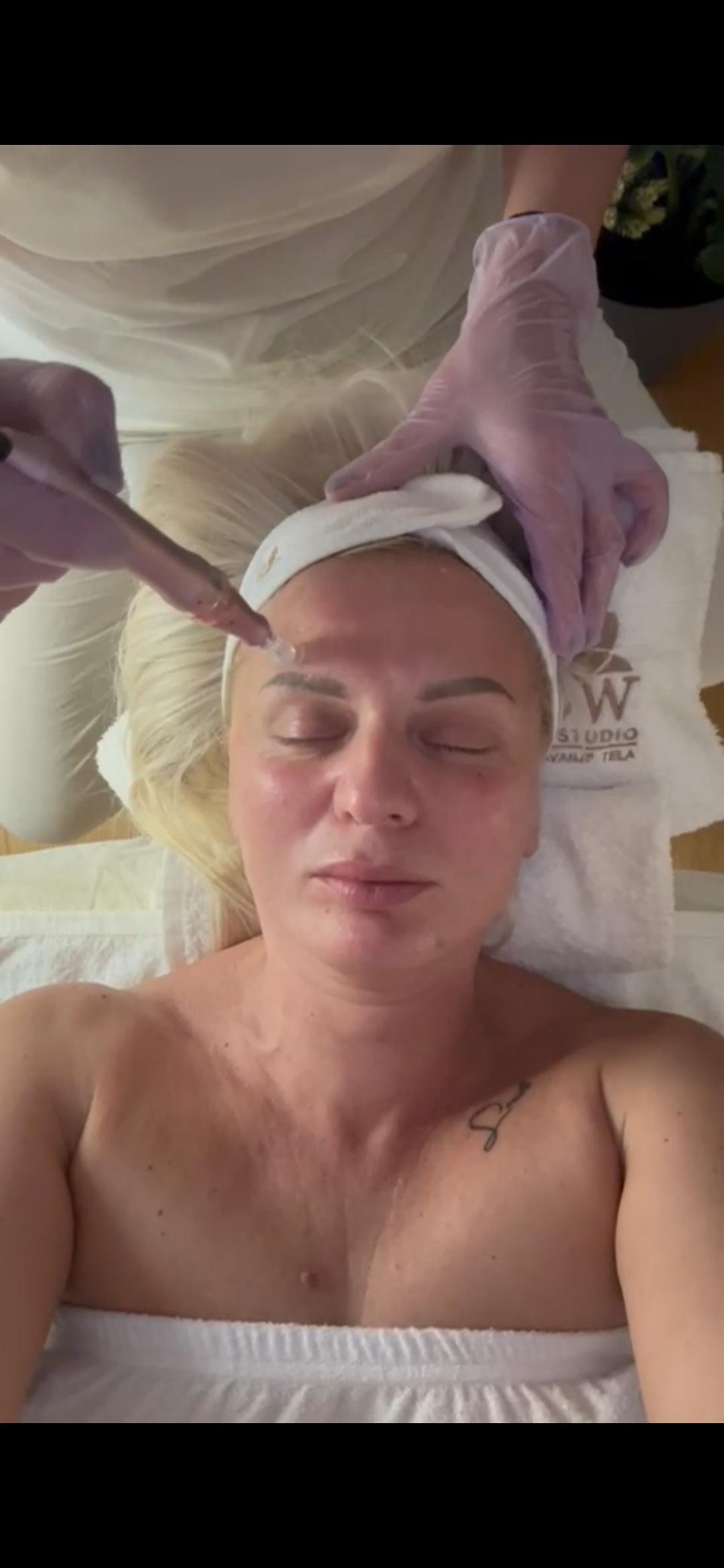 Dermapen microneedling tretman lica;lica,vrata i dekoltea - Glow Holistic Studio, Beograd Dermaroler i dermapen Lice Dermaroler i dermapen, Beograd, Novi Beograd blokovi, Belville, Savski kej