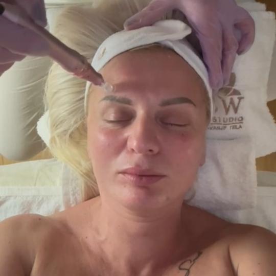 Glow Holistic Studio #beograd Dermaroler i dermapen Dermapen microneedling tretman lica;lica,vrata i