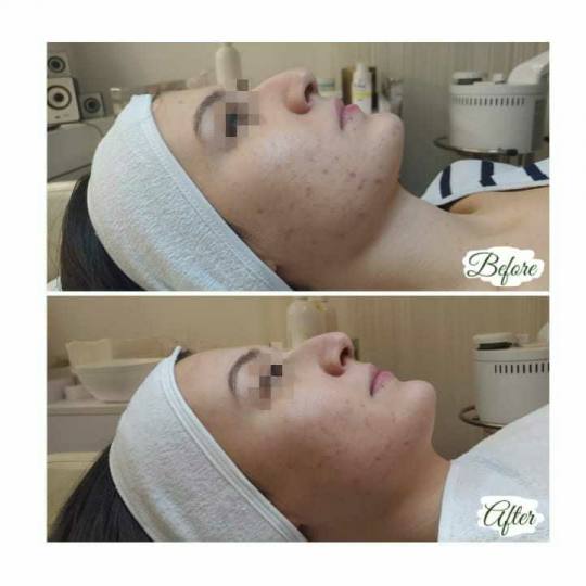 Iva Beauty Lab #beograd Tretman lica Higijenski tretman lica Higijenski ili, kako ga još zovu, klas