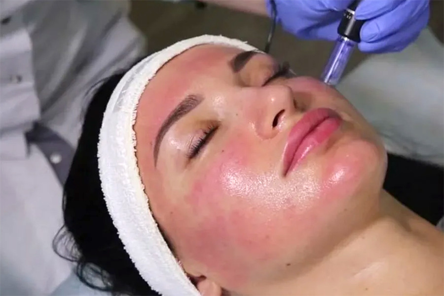 Mezoterapija (sa dermapenom)- Tretman protiv pigmentacije - Beauty and me, Novi Sad Tretman lica Lice Tretman lica, Novi Sad, Grbavica, Liman, Adamićevo
