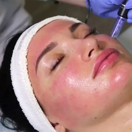 Beauty and me #novisad Tretman lica Mezoterapija (sa dermapenom)- Tretman protiv pigmentacije Mezote