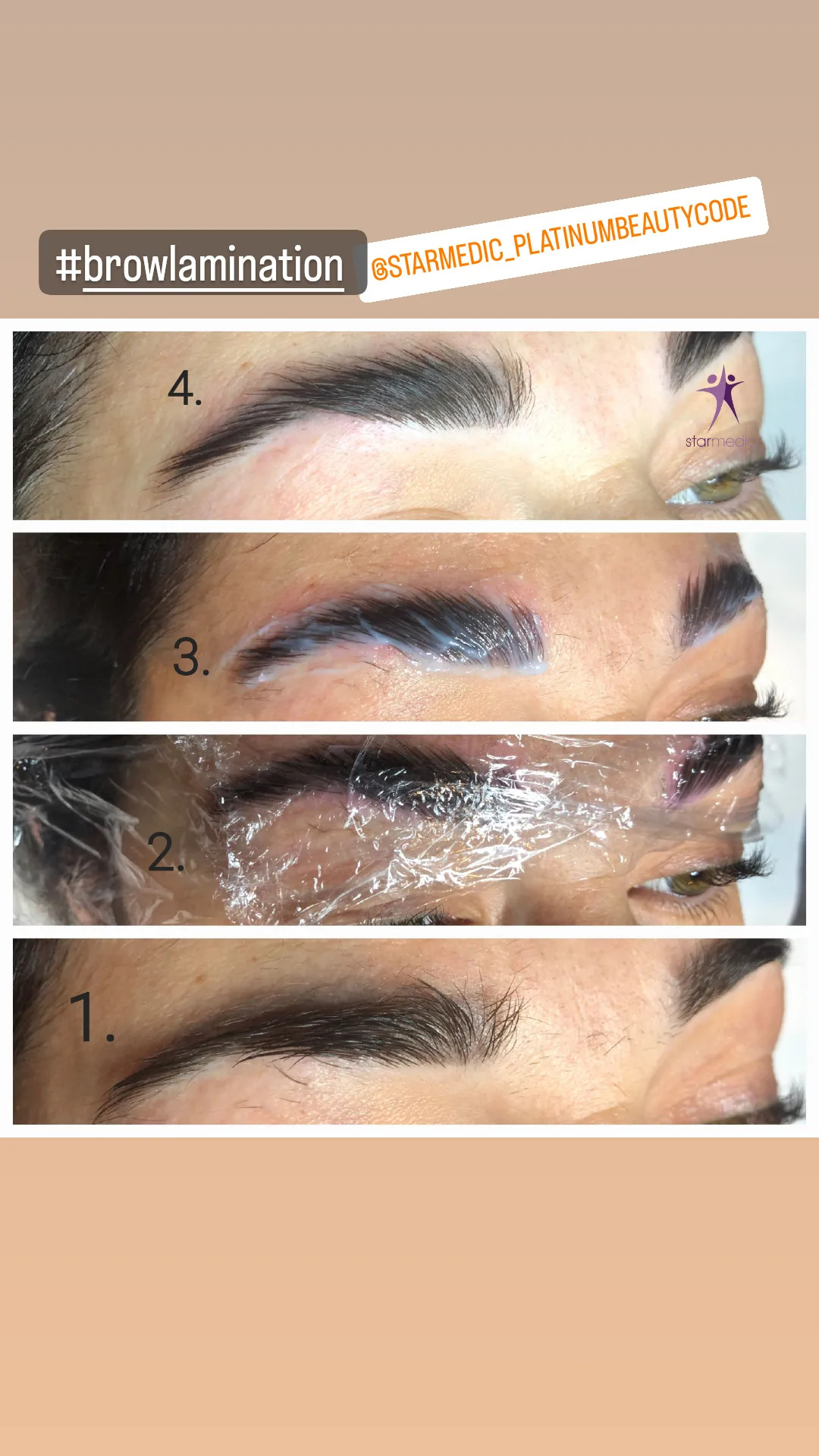 Brow lift - Starmedic, Beograd Trepavice Lice Trepavice, Beograd, Vračar, Čubura, Crveni krst
