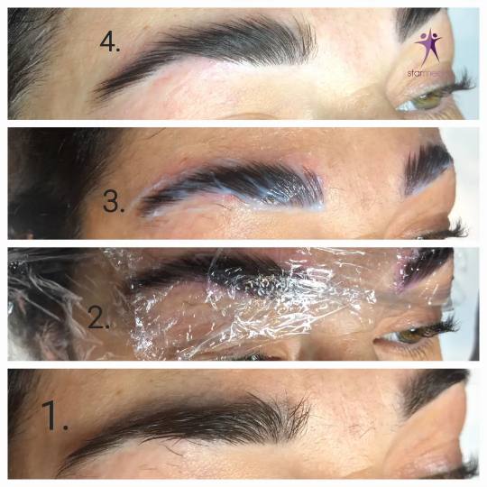 Starmedic #beograd Trepavice Brow lift