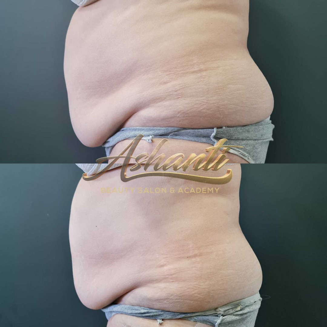 Ashanti Beauty Salon & Academy #beograd Tretmani tela Ice Body Sculpting