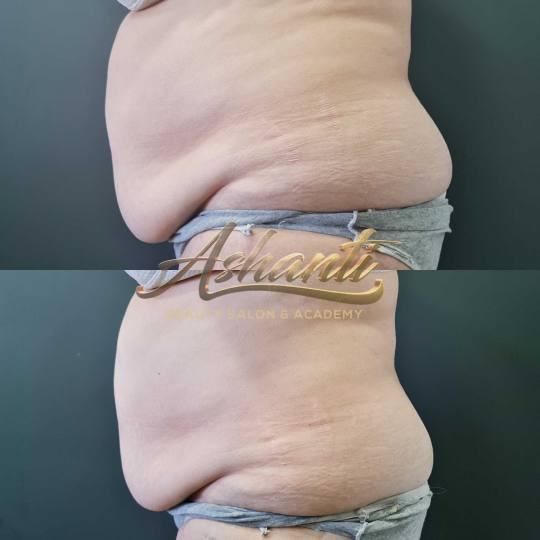 Ashanti Beauty Salon & Academy #beograd Tretmani tela Ice Body Sculpting