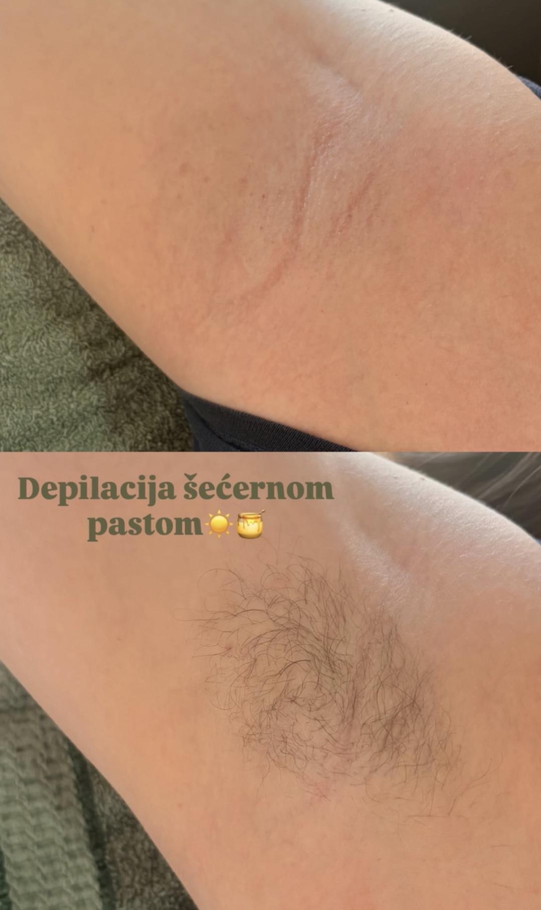 Almari Beauty Concept #kragujevac Depilacija šećernom pastom Depilacija pazuha šećernom pastom - za dame