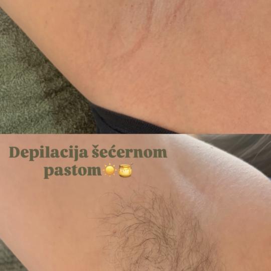 Almari Beauty Concept #kragujevac Depilacija šećernom pastom Depilacija pazuha šećernom pastom -