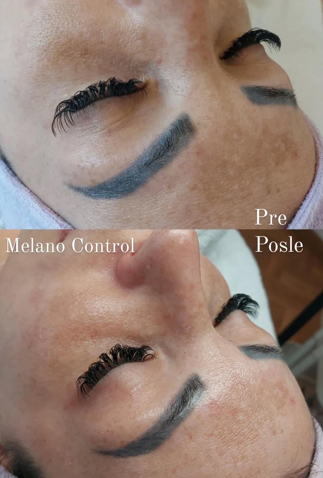 LYS by Royal Beauty Switzerland #nis Tretman lica Melano control sistem - tretman lica