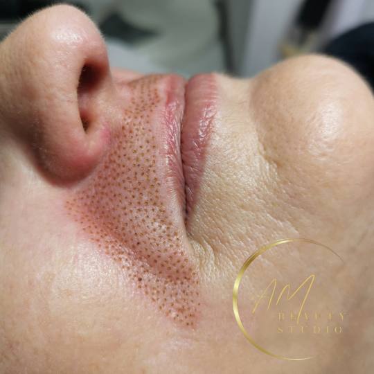 AM BEAUTY STUDIO #odzaci Radiotalasni i ultrazvučni tretmani Plasma pen - pušačke bore