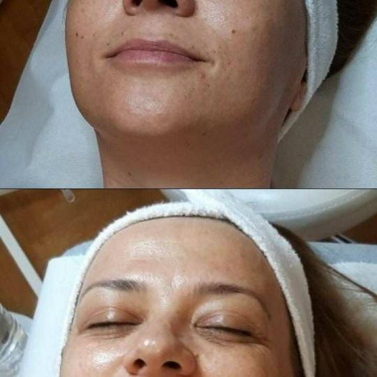 Skin Expert Aesthetic & Laser centar #beograd Radiotalasni i ultrazvučni tretmani Radiotalasni lift