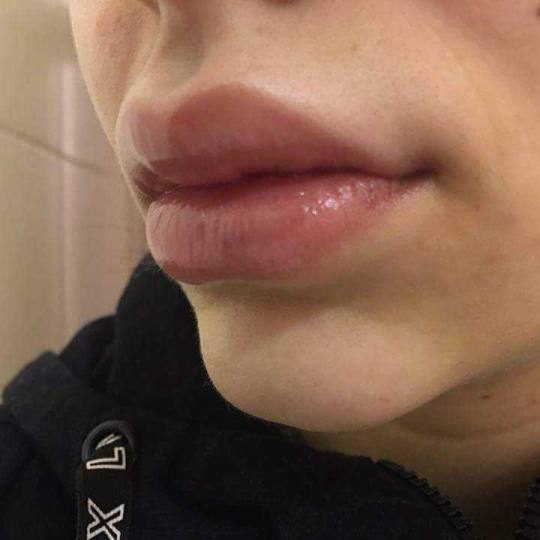 Womanizer #beograd Kozmetički doktori punjenje usana biopolimerom!! Popunjavanje usana bipolimerom 