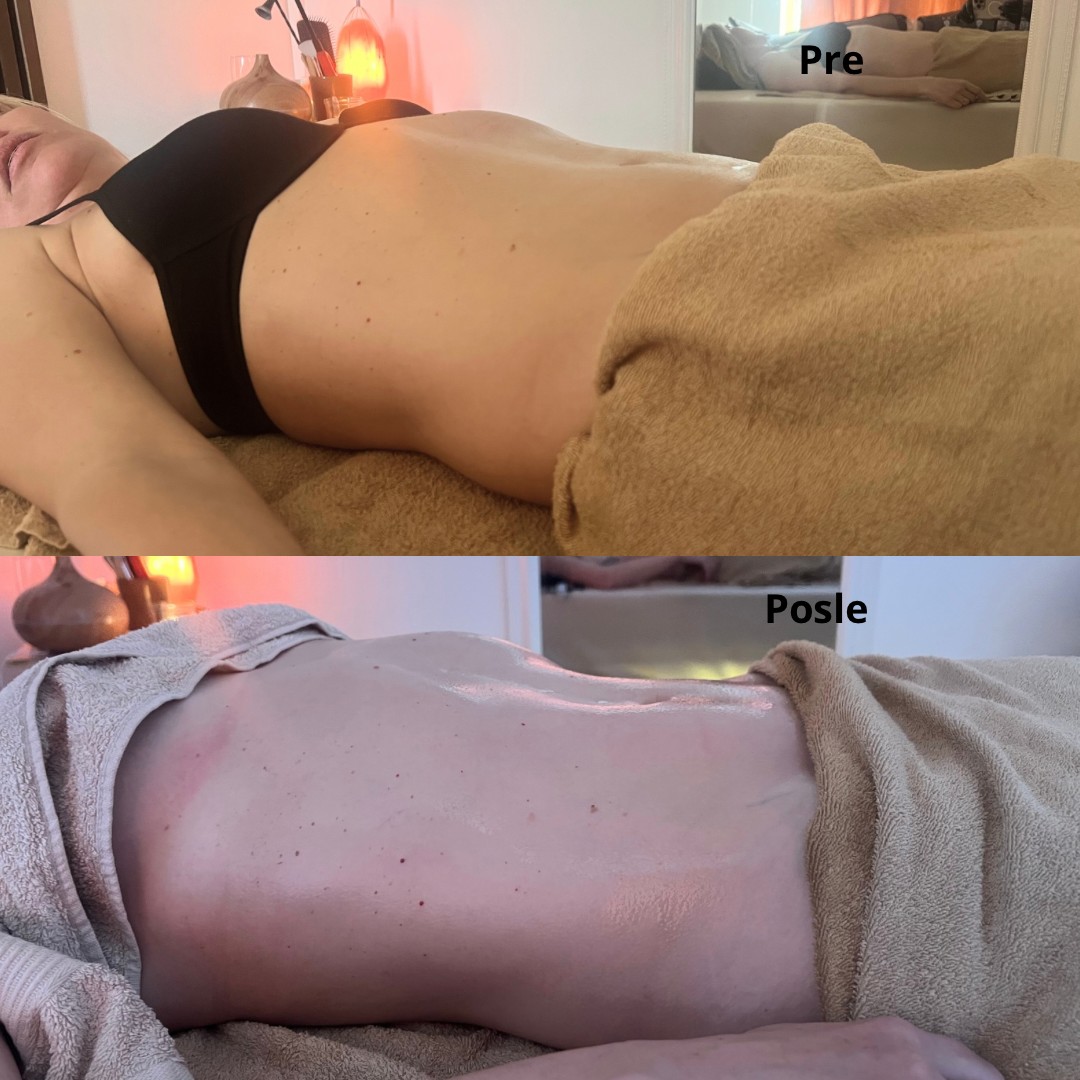 Brazilsko lipomodelovanje - stomak - Zgodnica, Beograd Anticelulit masaža Masaža Anticelulit masaža, Beograd, Jajinci