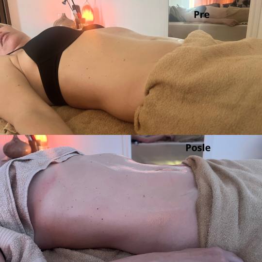 Zgodnica #beograd Anticelulit masaža Brazilsko lipomodelovanje - stomak Brazilsko lipomodelovanje u