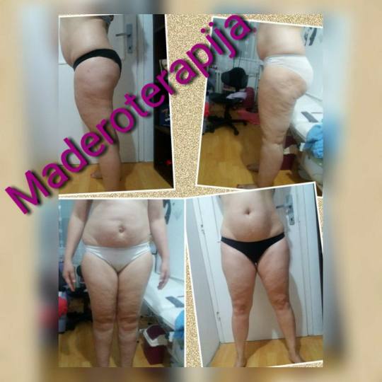 First lady 2 #beograd Maderoterapija