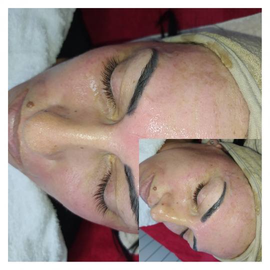 Akademija Stefanović #beograd Dermaroler i dermapen Higijenski tretman + mikrodermoabrazija + derma