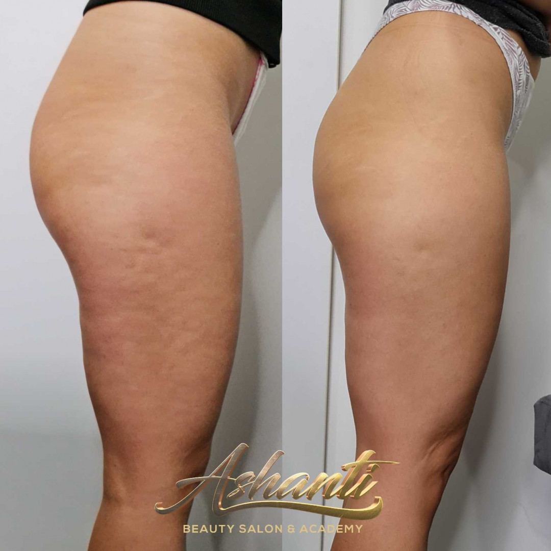 Ashanti Beauty Salon & Academy #beograd Tretmani tela Ultrazvučna kavitacija + radiotalasni lifting - po regiji