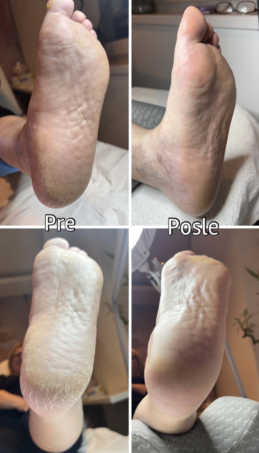 Simestetic studio #beograd Medicinski pedikir Polu medicinski pedikir + rubber baza