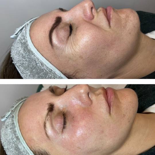 Beauty and nutrition #beograd Tretman lica Botox prah+dermapen+voćne kiseline+serumi za anti age+ma