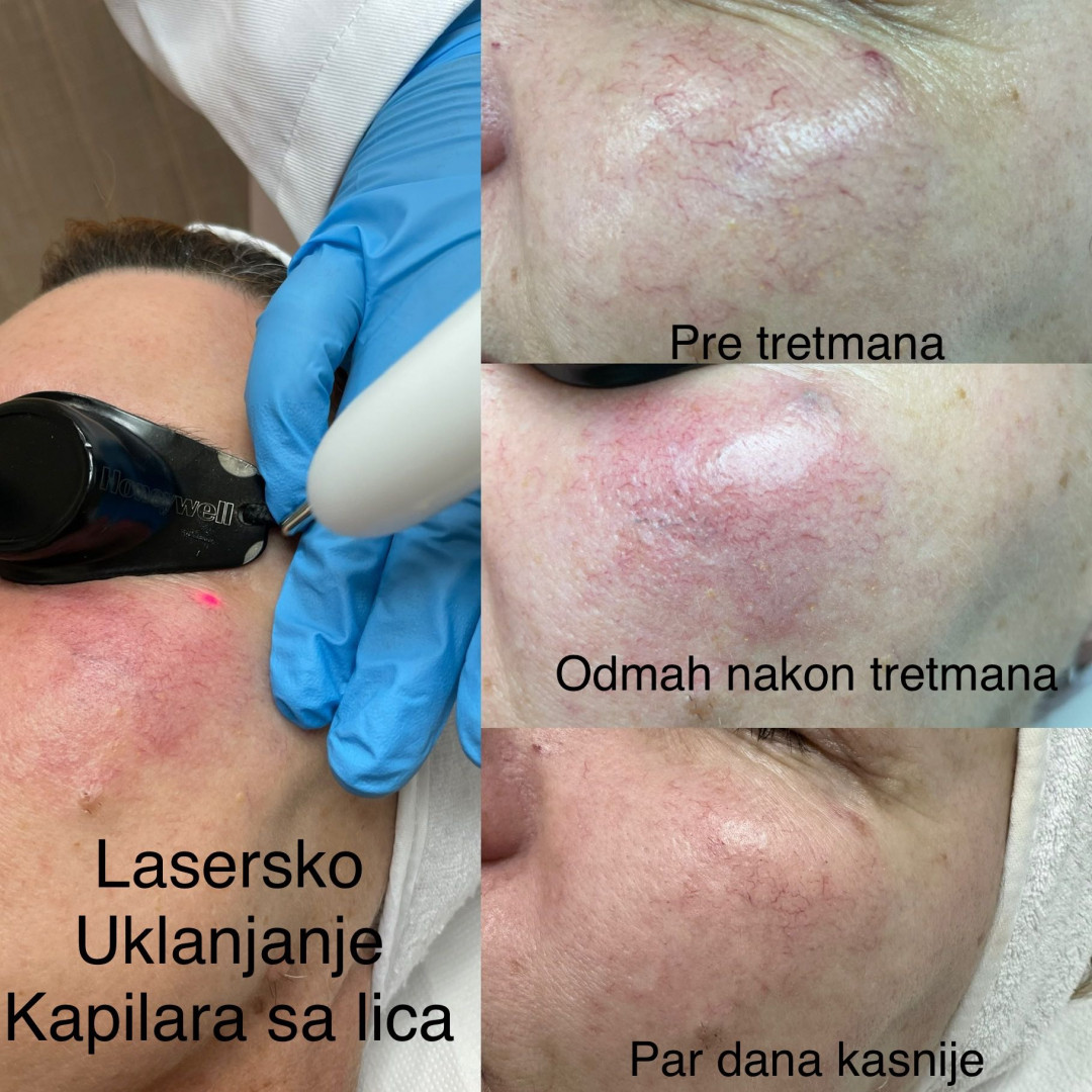 Poliklinika Marić #novisad Tretman lica Lasersko uklanjanje kapilara - velika regija kapilara