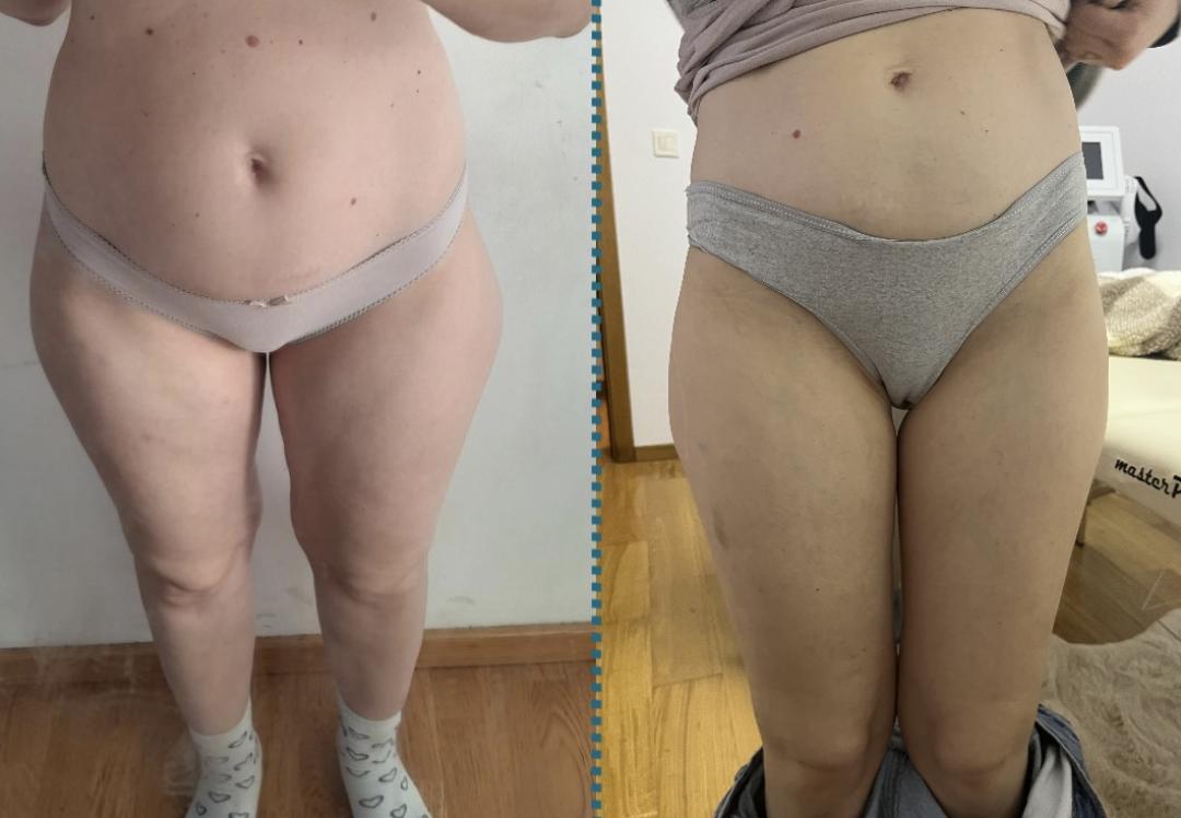 Amelini beauty concept #beograd Tretmani tela Perfect line tretman kavitacija/vakum/rf- 30 minuta