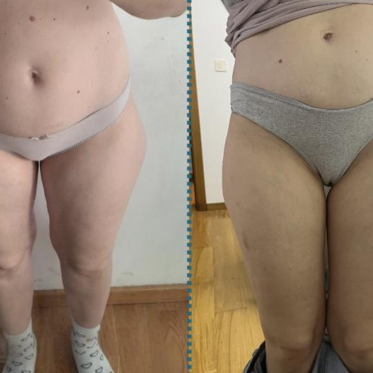 Amelini beauty concept #beograd Tretmani tela Perfect line tretman kavitacija/vakum/rf- 30 minuta