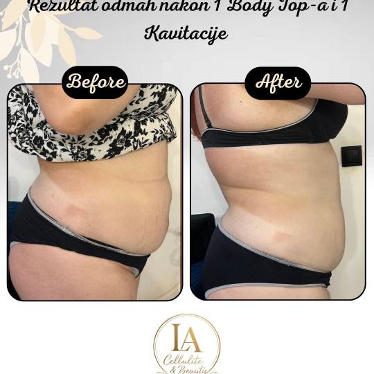 Lara Beauty 037 #krusevac Kavitacija Kavitacija + body top - paket od 3 tretmana