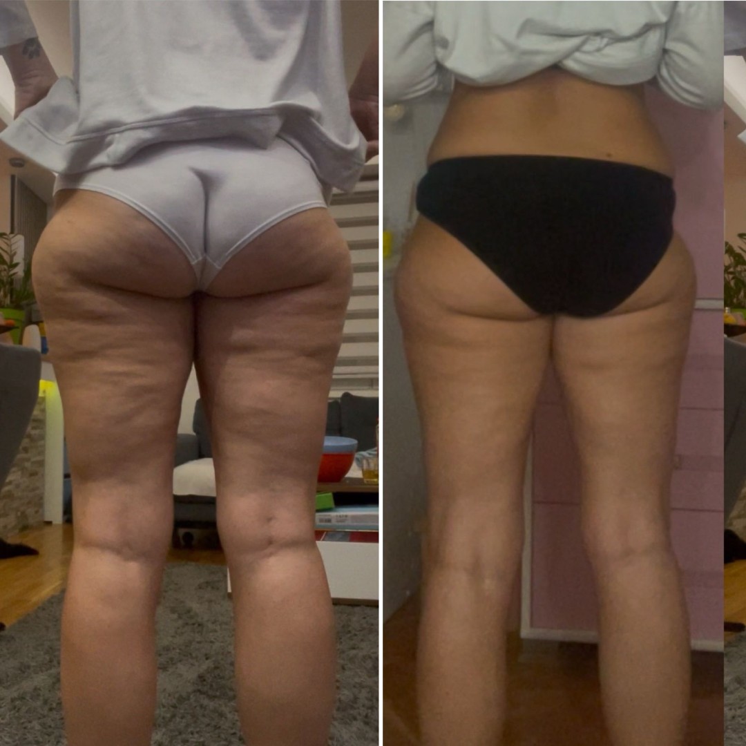 Shochwave AWT tretman + presoterapija gratis - paket od 6 tretmana - Boom - Zemun, Beograd Tretmani tela Telo Tretmani tela, Beograd, Zemun Centar