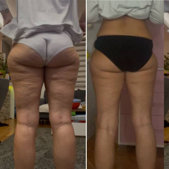 Boom - Zemun #beograd Tretmani tela Shochwave AWT tretman + presoterapija gratis - paket od 6 tretma