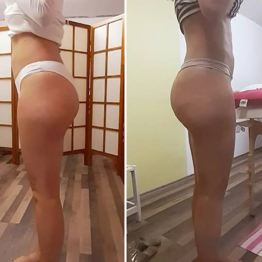 Migun centar relax #beograd Anticelulit masaža Maderoterapija noge + gluteus+stomak 50 min. Uz pomo