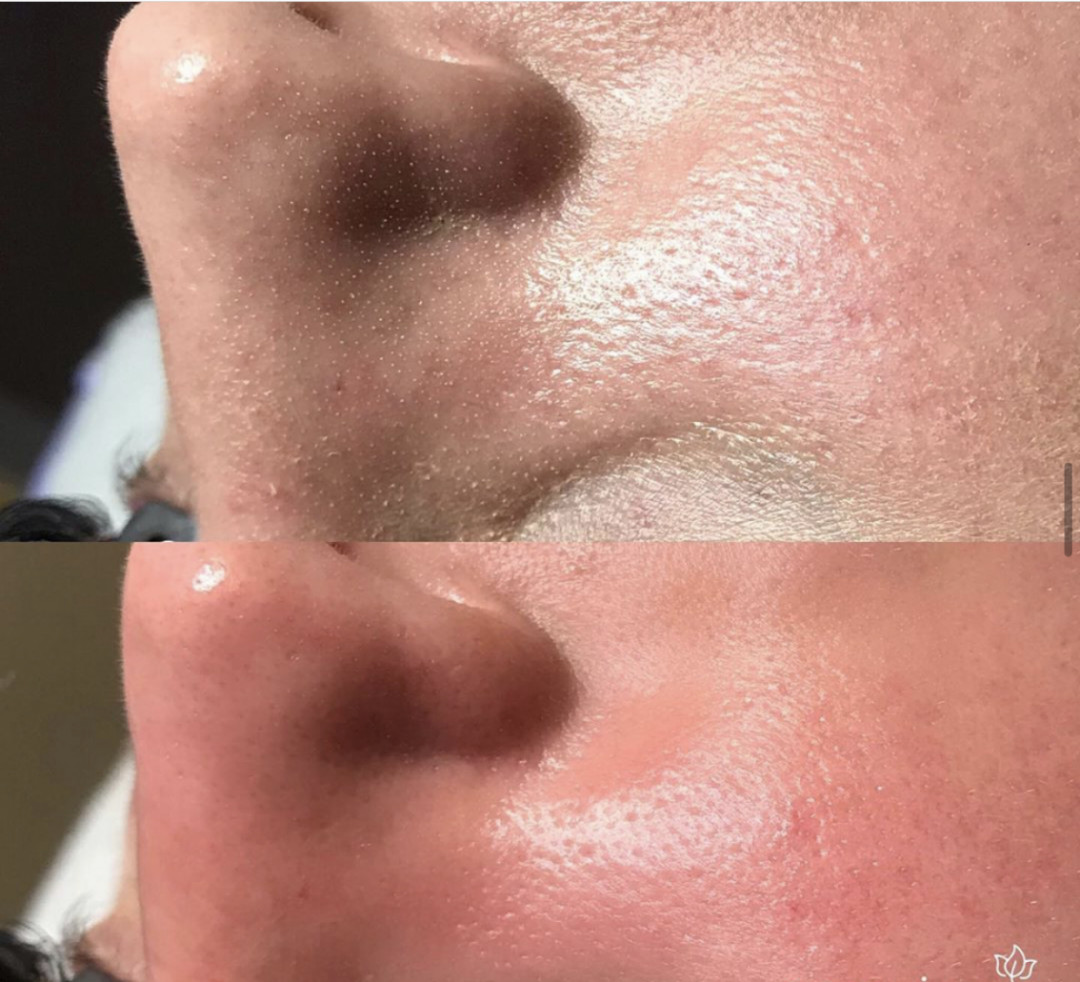 SkinLab Beauty Centar #novisad Tretman lica Dijamantska mikrodermoabrazija