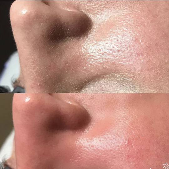 SkinLab Beauty Centar #novisad Tretman lica Dijamantska mikrodermoabrazija Dijamantska mikrodermoabr