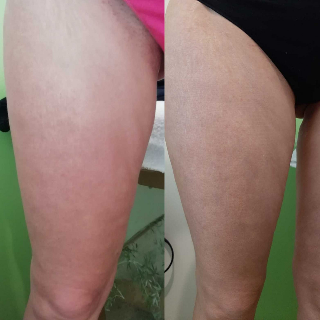 Olja Beauty #beograd Lifting / zatezanje kože HiFu tretman lica - po regiji