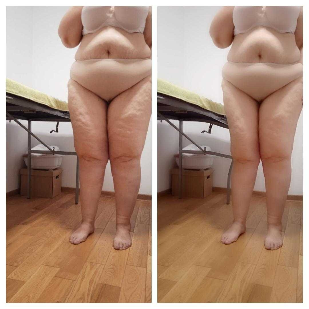 Golden Duo massage & Wellness studio #beograd Anticelulit masaža
