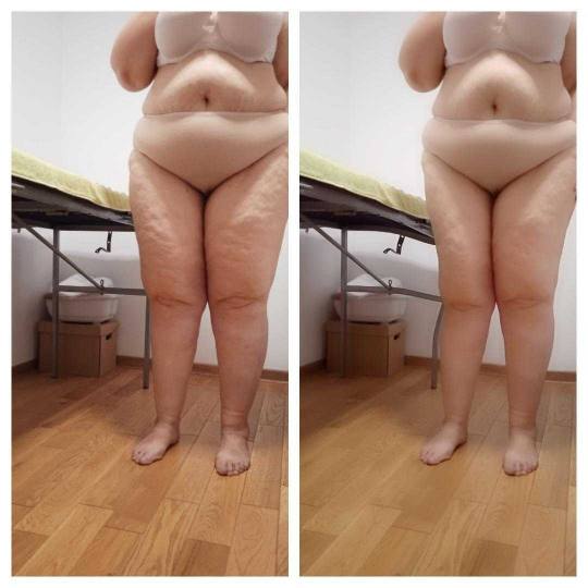 Golden Duo massage & Wellness studio #beograd Anticelulit masaža Nas model pre i posle 5 tretmana b