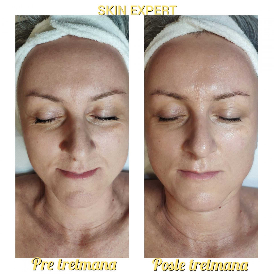 Skin Expert Aesthetic & Laser centar #beograd Mezoterapija lica Neinvanzivna Mezoterapija / Mezoporacija + ultrazvuk
