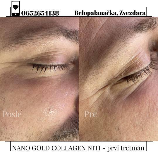 Oui Oui #beograd Tretman lica Tretman Nano Gold Collagen niti - po regiji