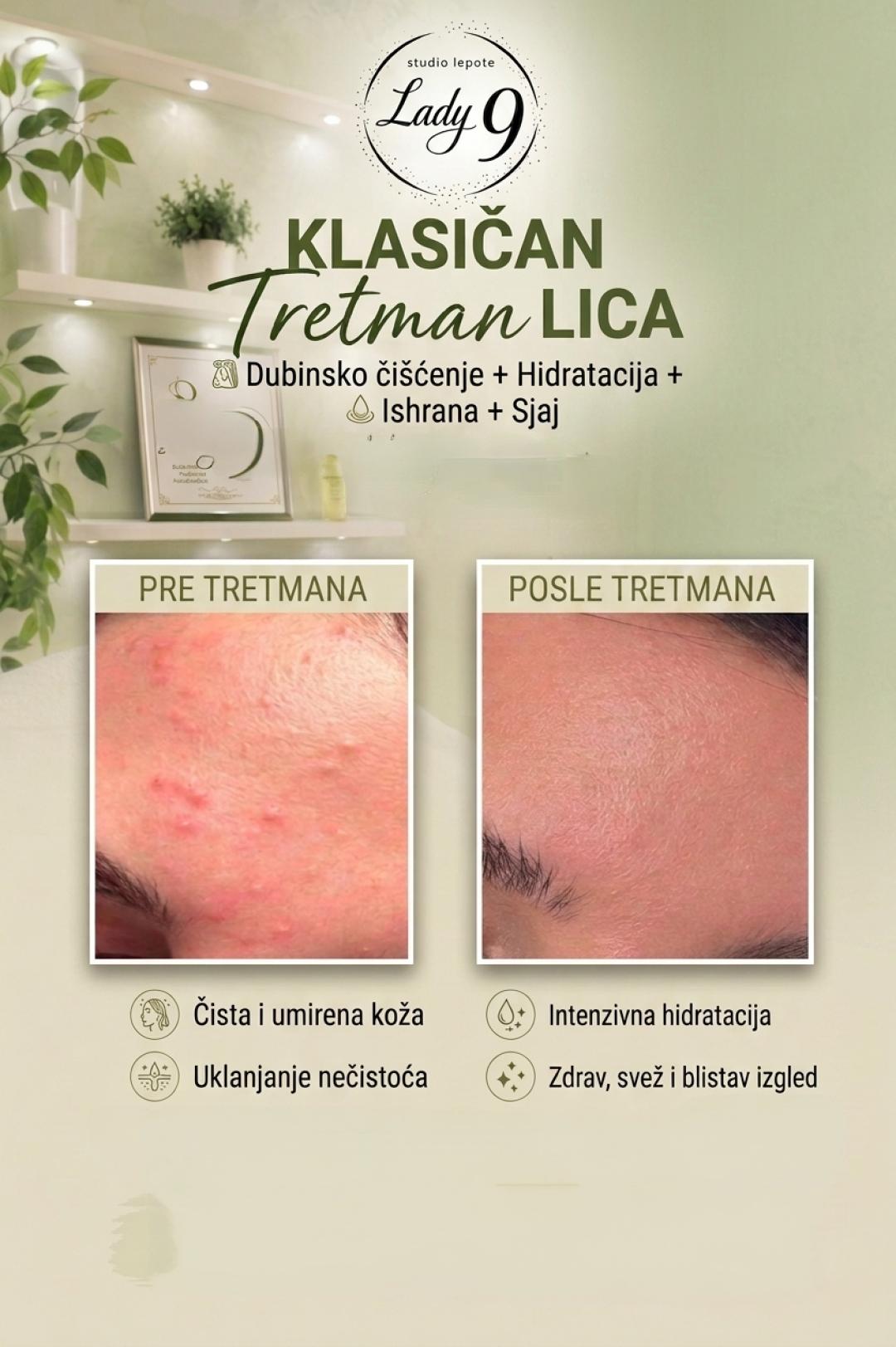 Klasičan higijenski tretman lica za problematičnu kožu + serum niacinamid - Lady 9 - Zemun, Beograd Tretman lica Lice Tretman lica, Beograd, Zemun Centar