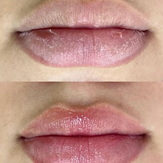 L’Avenue #beograd Mezoterapija lica Hydralips-mezoterapija usana hijaluronom