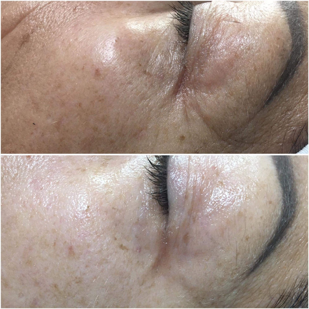 Look at me #beograd Tretman lica Eyelid booster