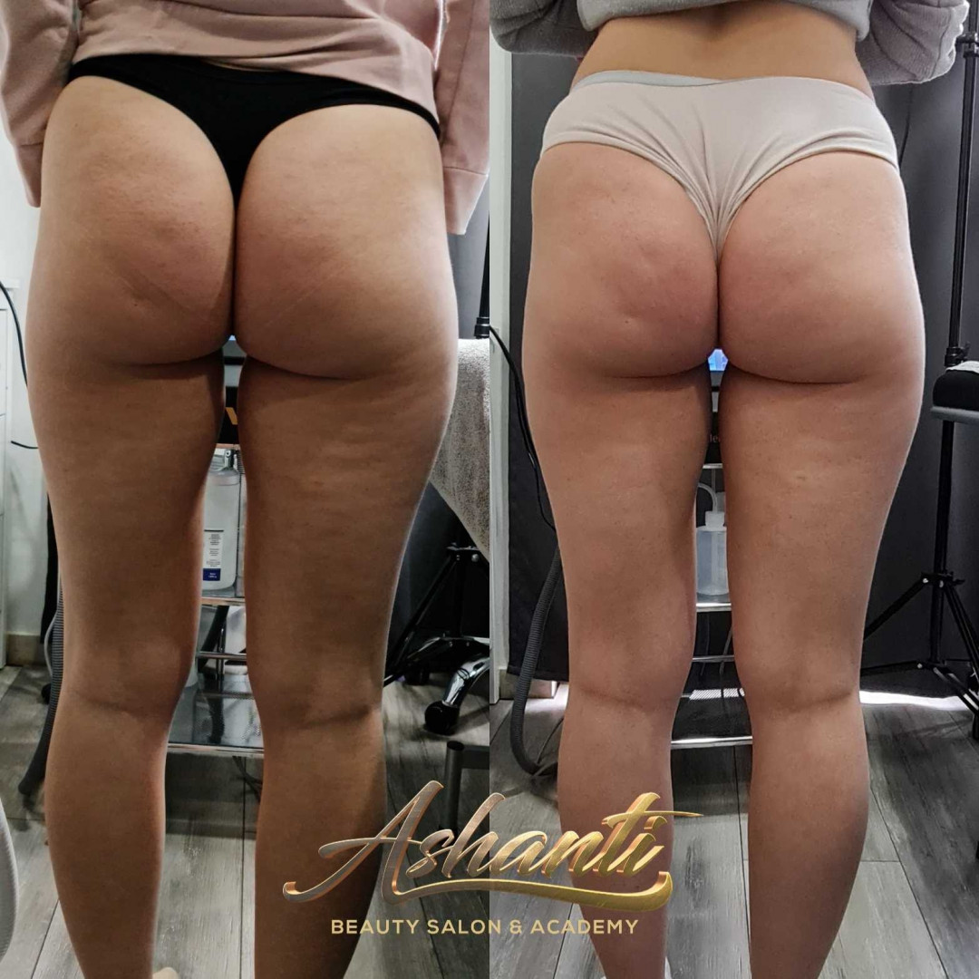 Ashanti Beauty Salon & Academy #beograd Tretmani tela Ultrazvučna kavitacija + vakum sa bipolarnim radiotalasima - po regiji